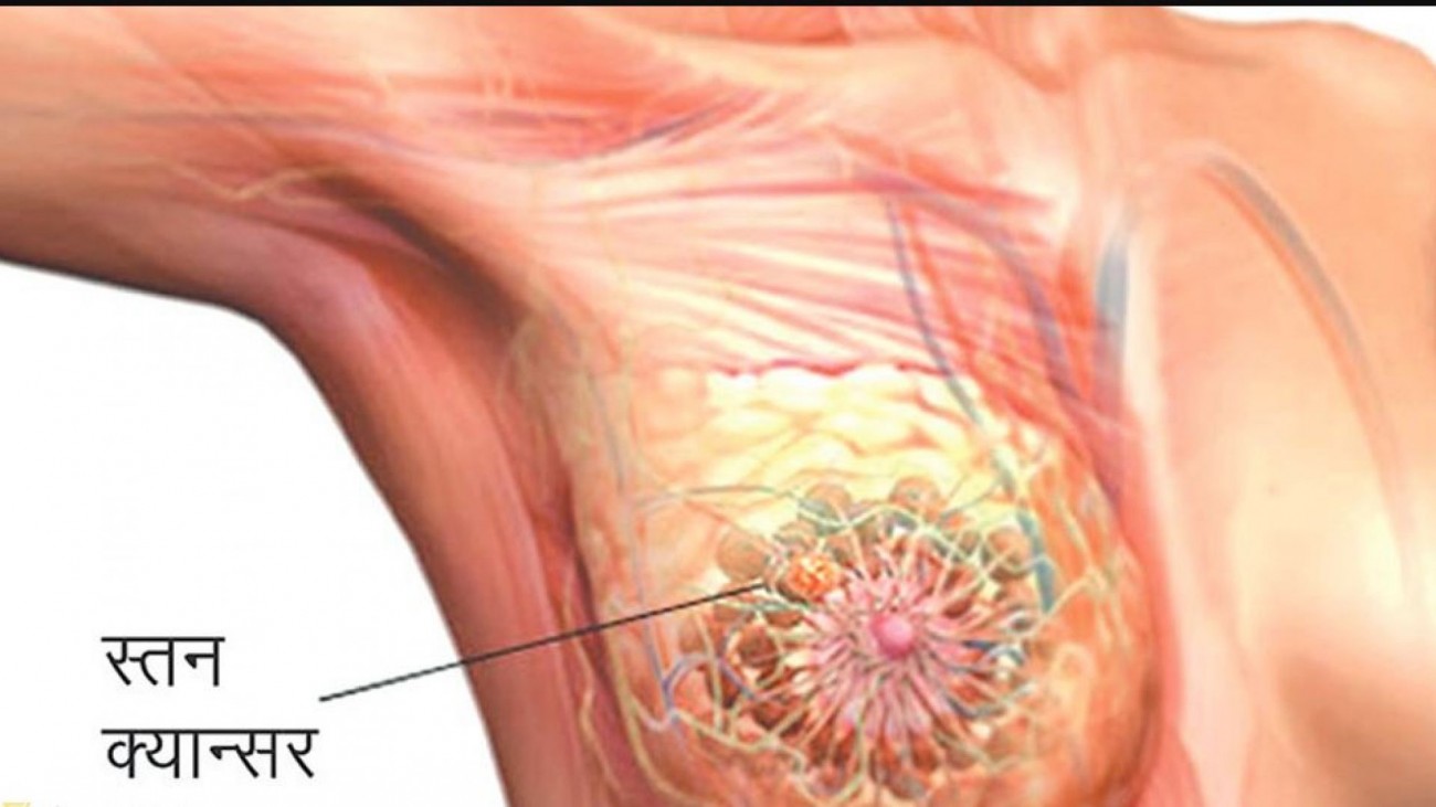 breast-cancer-1602407082.jpg